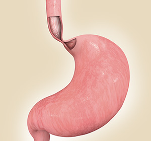 Heller Myotomy(Surgery for Achalasia) educational picture