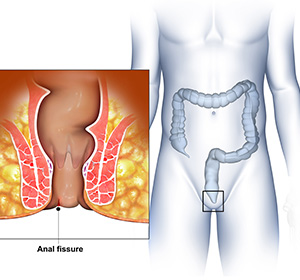 Anal Fissure educational picture