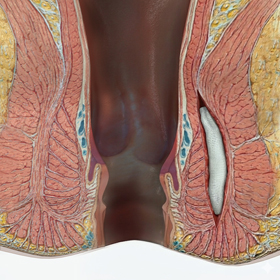 Anal Fistula Treatment - picture