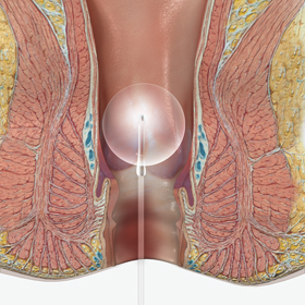 Anorectal Manometry - picture