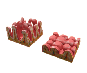 Celiac Disease - picture