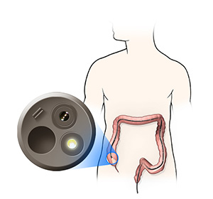 Colonoscopy educational picture