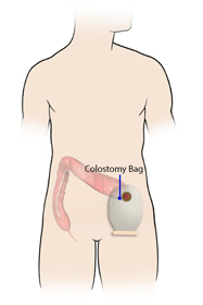Colostomy - picture