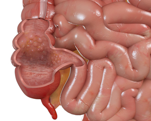 Crohn’s Disease - picture