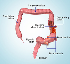 Diverticular Disease educational picture
