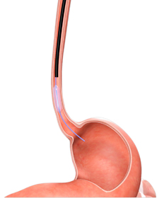 EGD with Dilation - picture