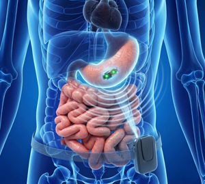 EGD with pH Study - picture