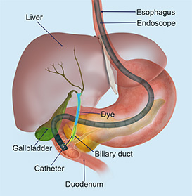 Endoscopic Retrograde Cholangiopancreatography (ERCP) educational picture