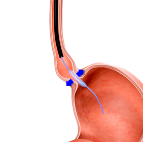 Endoscopic Treatment for Achalasia - picture