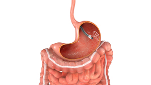 Endoscopic Ultrasound (EUS) - picture