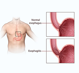 Eosinophilic Esophagitis educational picture