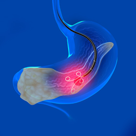 EUS-guided Cystogastrostomy - picture