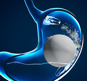 Gastric Balloon - picture