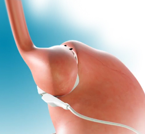 Gastric Band Removal - picture