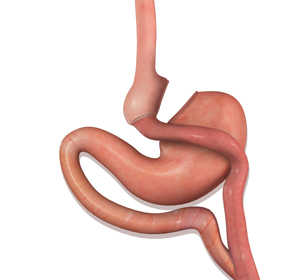 Gastric Bypass - picture