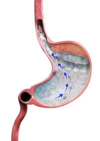 Gastroesophageal Reflux Disease (GERD) - picture