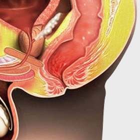 Gastrointestinal Bleeding - picture