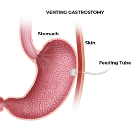 Gastroparesis - picture