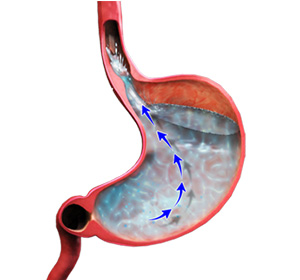 Laparoscopic Reflux Surgery educational picture