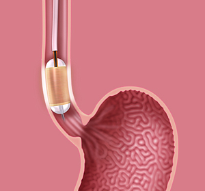 Ablation for Barrett’s Esophagus - picture