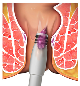 Hemorrhoidal Band Ligation - picture