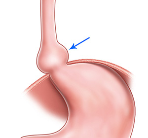 Hiatal Hernia Repair educational picture