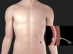PEG Tube Insertion and Management - picture