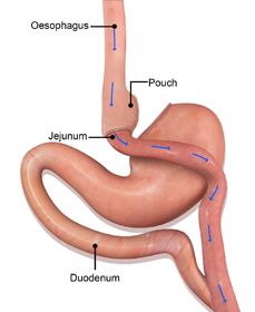 Revision Weight Loss Surgery - picture