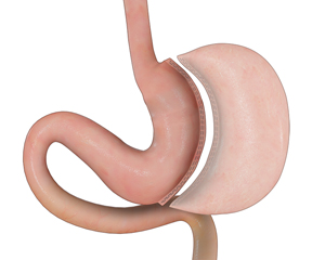 Sleeve Gastrectomy - picture