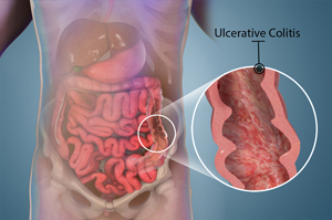 Ulcerative Colitis - picture