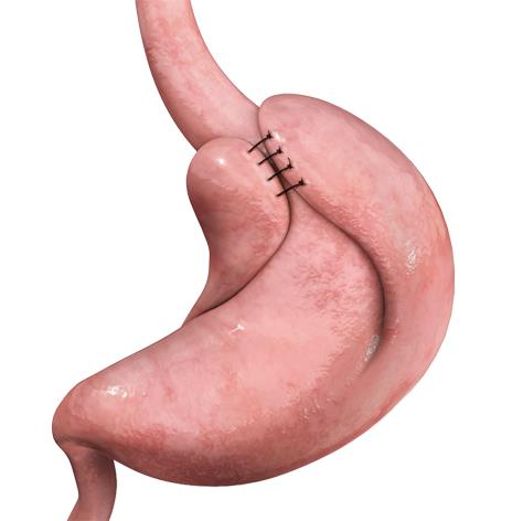 Gastric & Esophageal Surgery