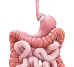 Metabolic Surgery