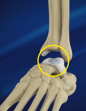 Talar OCD (Osteochondritis Dissecans)