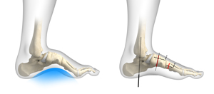 Cavovarus Reconstruction