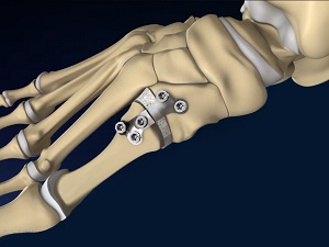 Foot & Ankle Deformity Correction
