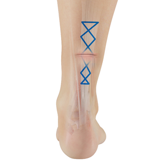 Foot Tendon Repair