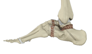 Hindfoot Reconstructive Procedures