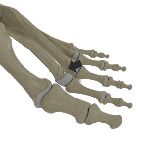 Metatarsal Osteotomy