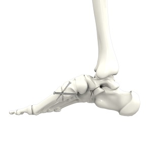 Midfoot Fusion