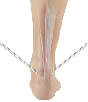 Minimally Invasive Achilles Repair