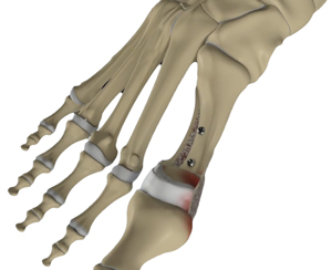 Minimally Invasive Foot and Ankle Reconstruction