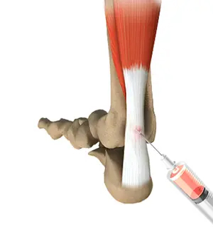 Orthobiologic Treatments for Ankle Injury
