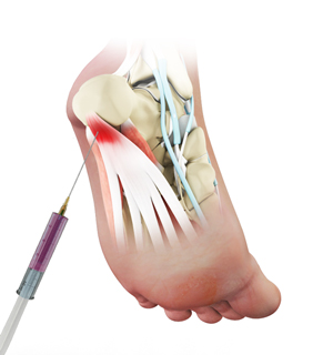 Orthobiologic Treatments for Plantar Fasciitis