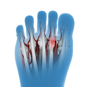 Plantar Plate Injuries