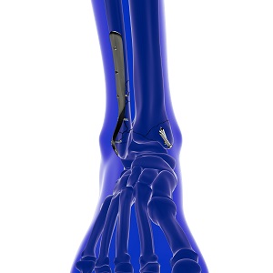 Post-Traumatic Reconstruction of the Foot and Ankle