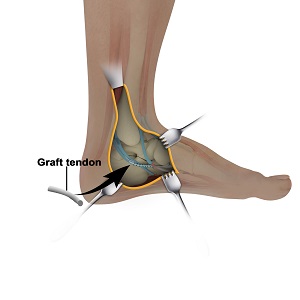 Posterior Tibialis Tendon Repair