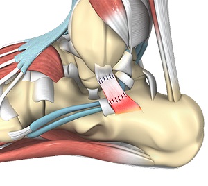 Revision Foot and Ankle Surgery