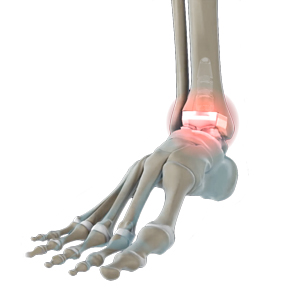 Revision Total Ankle Replacement