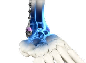 Syndesmosis with TightRope Fixation