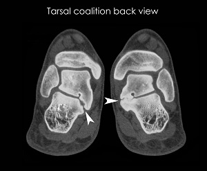 Tarsal Coalition